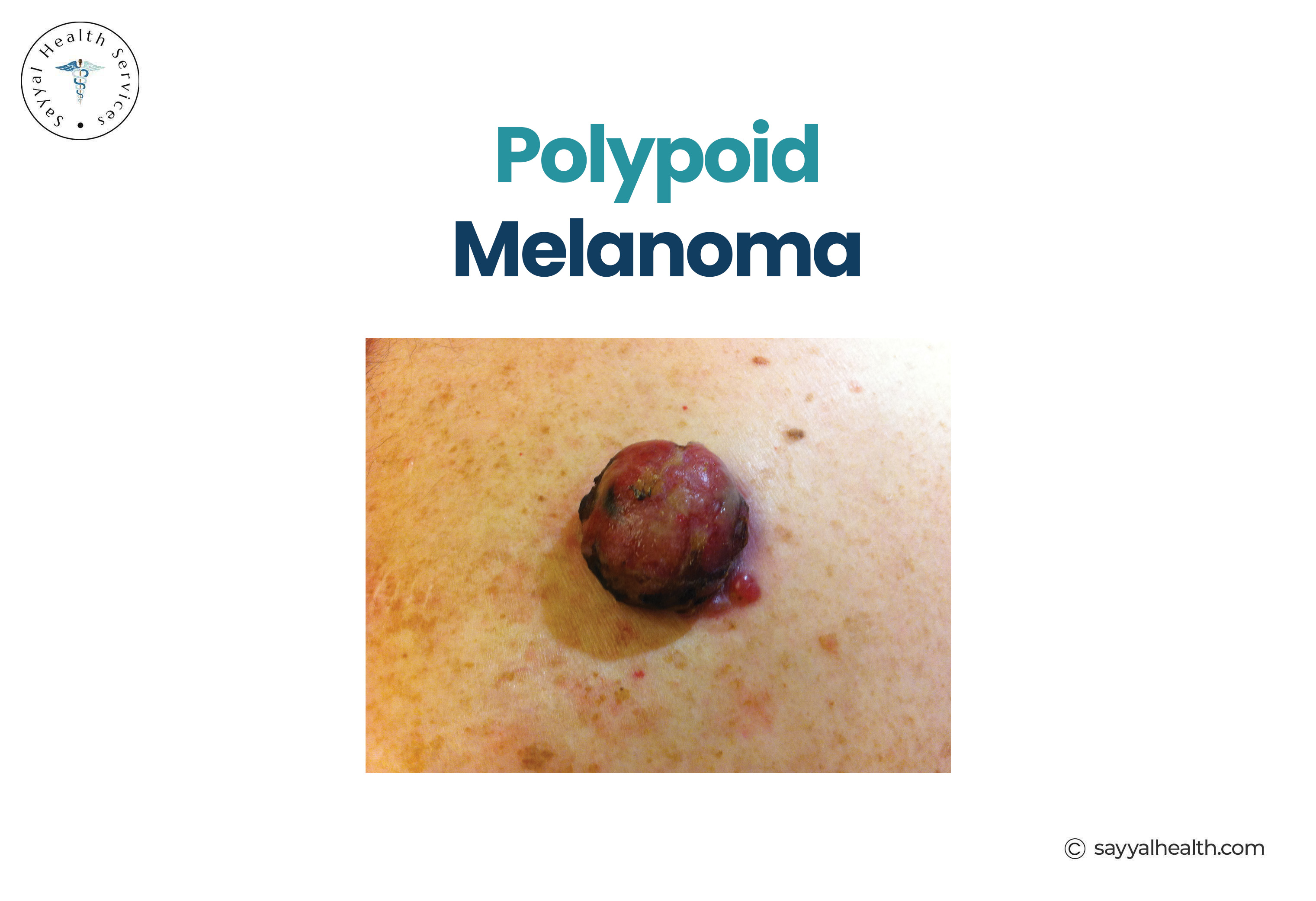 polypoid melanoma